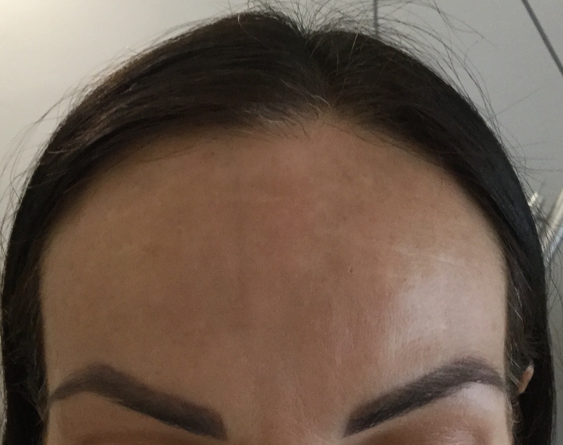 Melasma - Después del tratamiento